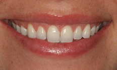 After Esthetic Crown Lengthening