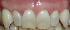 After Gum Grafts