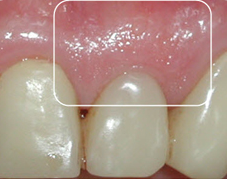 After Ridge Augmentation, the tooth looks more natural, emerging from the gum