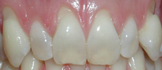 Receding Gums before Gum Grafts