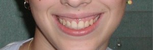 After crown lengthening surgery