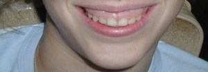 Before crown lengthening surgery