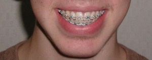 Gummy smile - after surgery