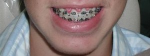 Gummy smile - before surgery