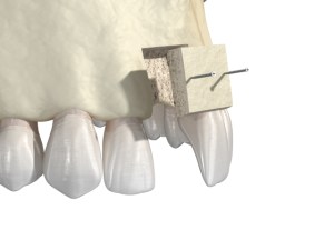 bone graft illustration