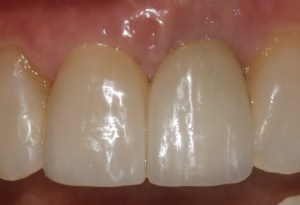 Close-up shot of an implant placed to replace a failing dental implant