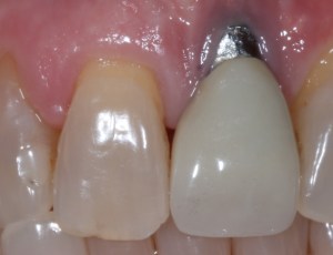 Close-up shot of a failing dental implant before replacement.