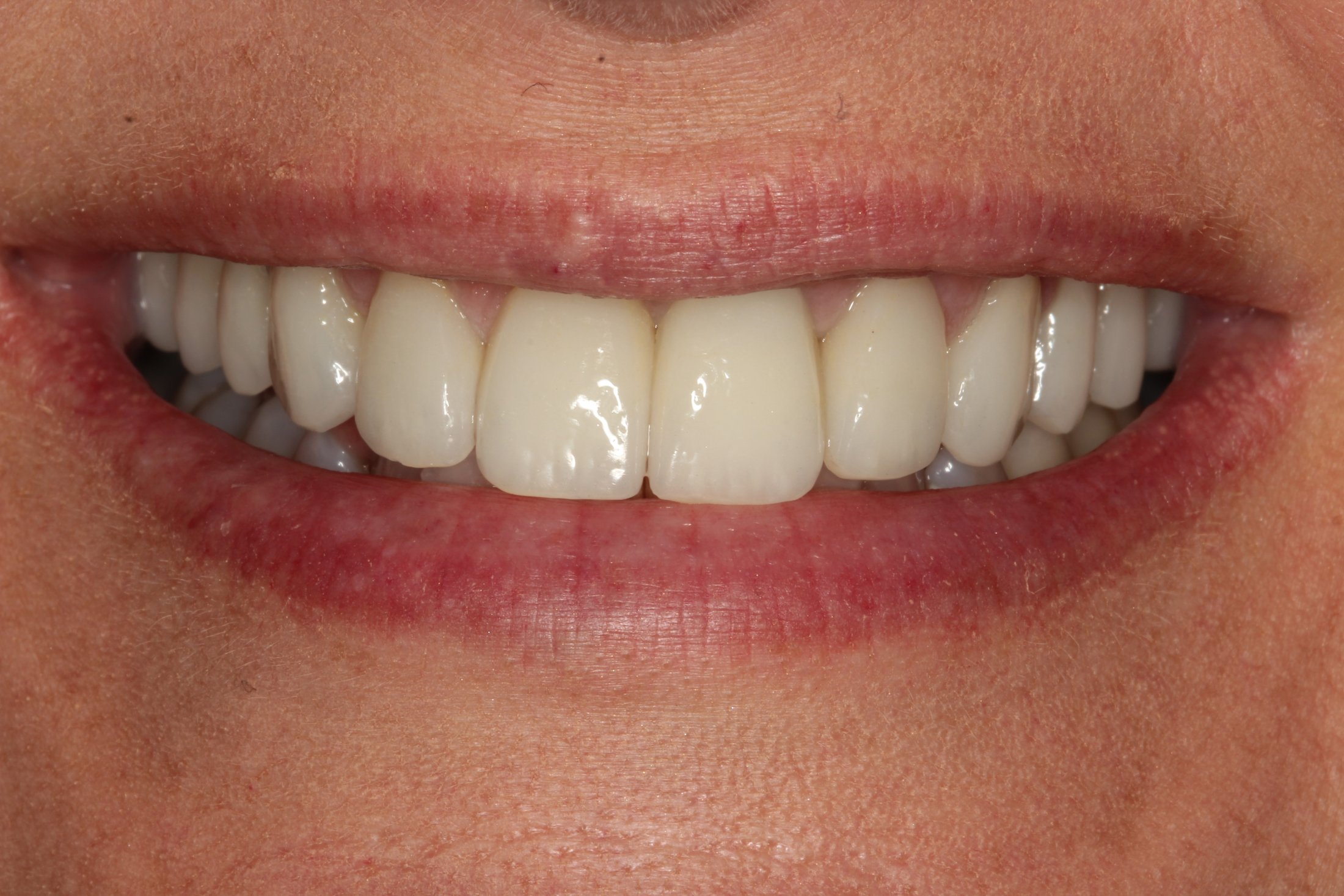 Dental Implants In Fort Myersundefined