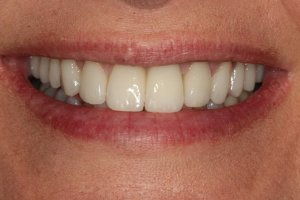 Photo of smiling teeth after replacement of front right tooth with a single dental implant