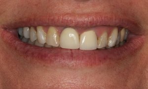 Photo of smiling teeth before replacement of front right tooth with a single dental implant