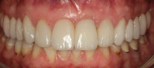 Close up shot of teeth after replacement of front right tooth with a single dental implant