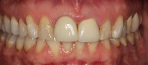 Close up shot of teeth before replacement of front right tooth with a single dental implant